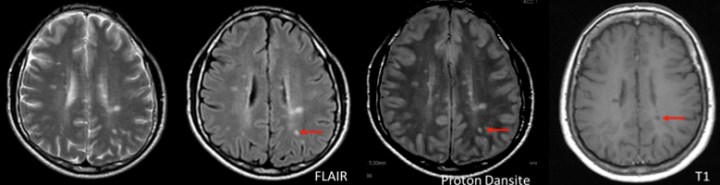 MRG-1: Tipik MS lezyonlarını gösteren aksiyel beyin kesiti