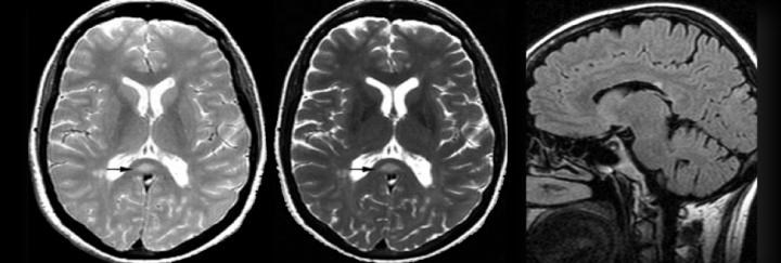 MRG-2: Periventriküler lezyonlar