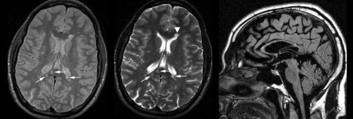 MRG-3: Beyin sapı ve serebellar pedinkül lezyonları