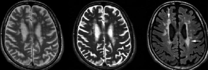 MRG-4: Periventriküler lezyon örneği