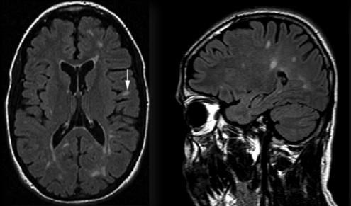 MRG-6: Jukstakortikal lezyonlar