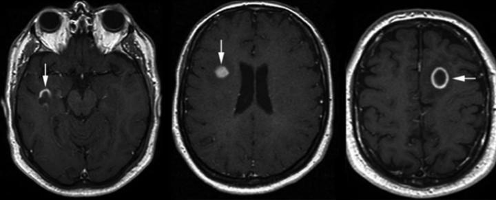 MRG-7: Gadolinyum tutan aktif lezyon