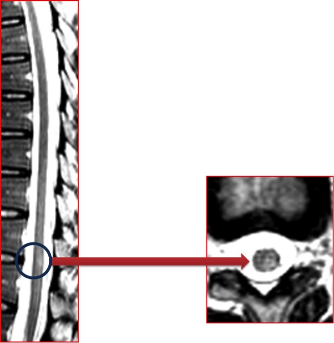 MRG-8: Spinal kord lezyonları