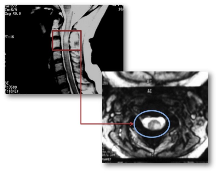 MRG-9: Spinal kord lezyonları